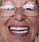 Carillas Dentales Snap On Smile (Incluye las 2)